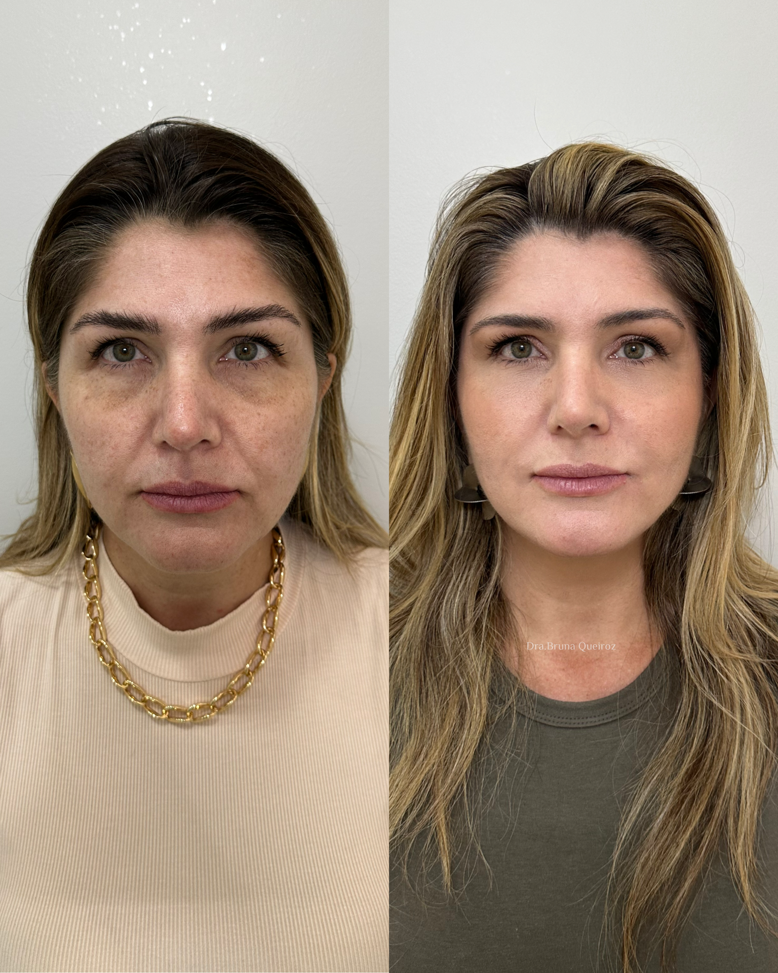 Embelezamento facial com delicadeza